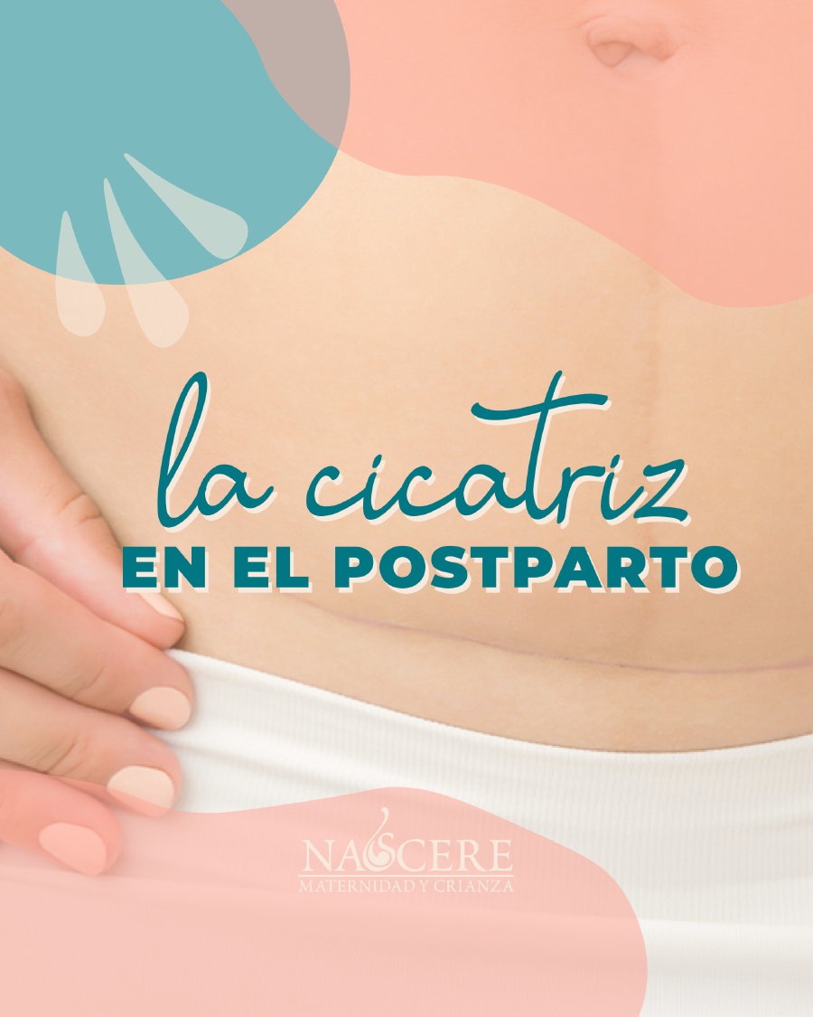 ¿Cómo tratar la #cicatriz de la #cesárea y cuáles son sus cuidados?